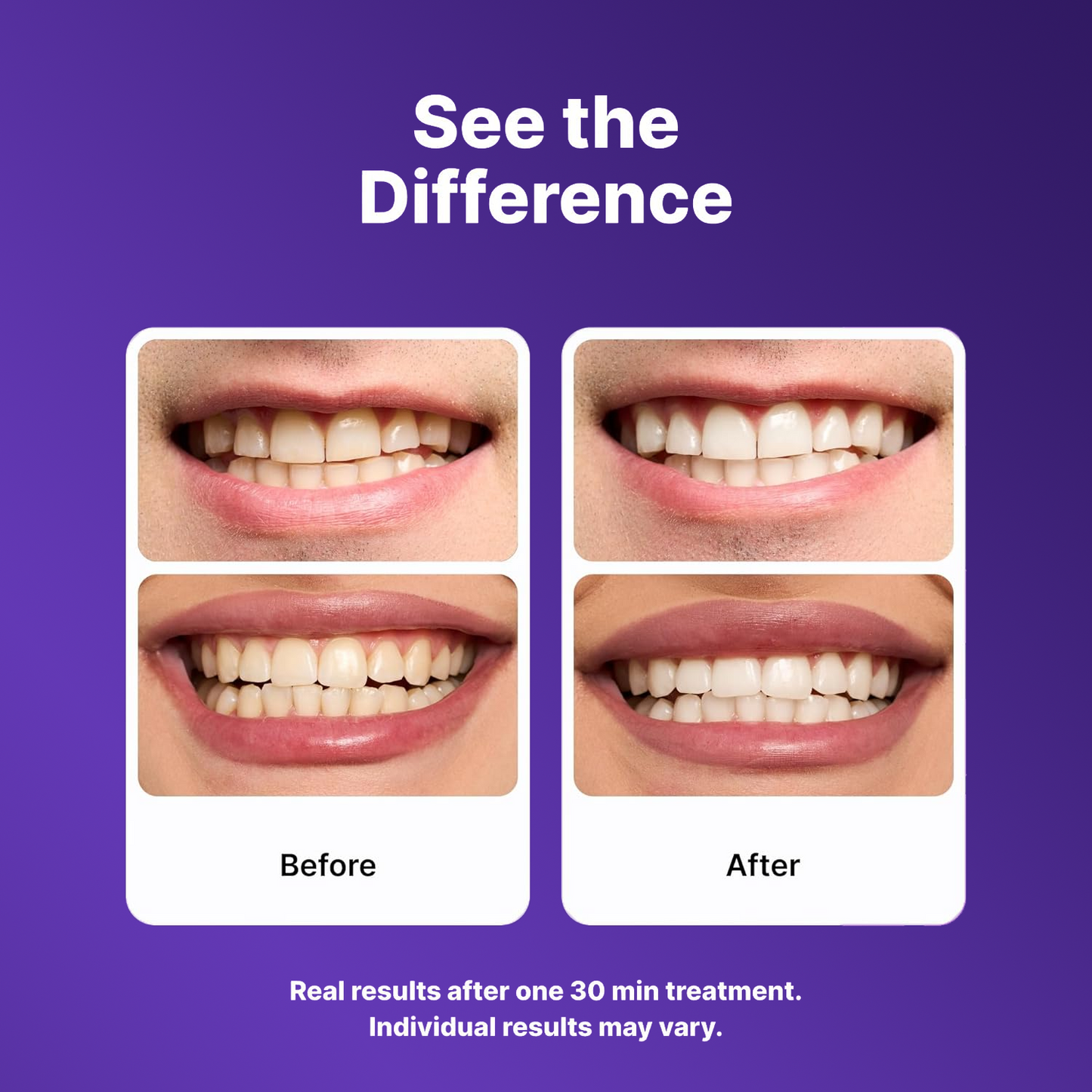 🔥Last Day 49% OFF - 🦷Purple Teeth Whitening Strips, Enamel-Safe Stain Removal💜